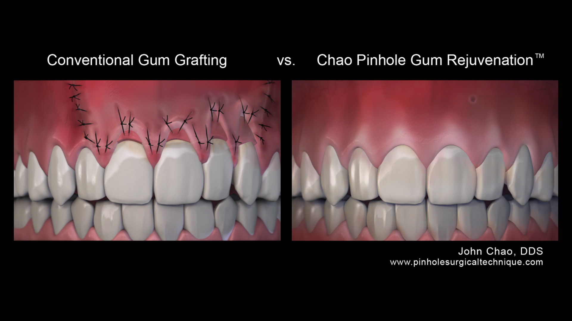 How do you fix receding gums?